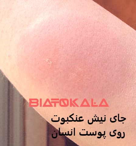 جای نیش عنکبوت 